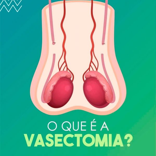 O Que é A Vasectomia Cub Clínica Urológica Da Bahia Urologista