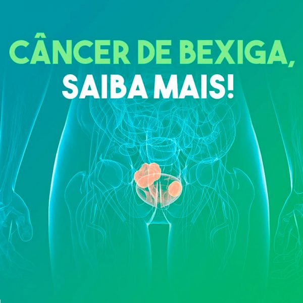 Saiba Mais Sobre O Câncer De Bexiga Cub Clínica Urológica Da Bahia Urologista Em Salvador 